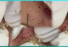 Big Cystic Acne Blackheads Extraction Blackheads & Milia, Whiteheads Removal Pimple Popping